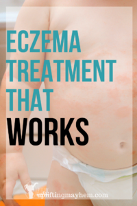 treating baby eczema baby skin care treating eczema