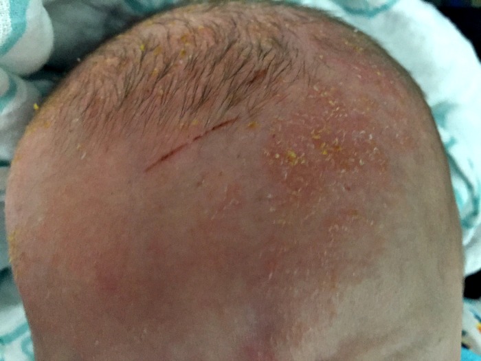 Eczema on babies: What I thought was cradle cap