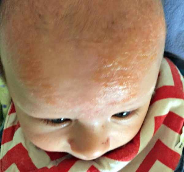 Eczema on Babies What We did for my Infant's Eczema That WORKED! Uplifting Mayhem