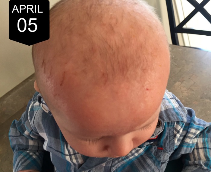 What we did for our infant's eczema
