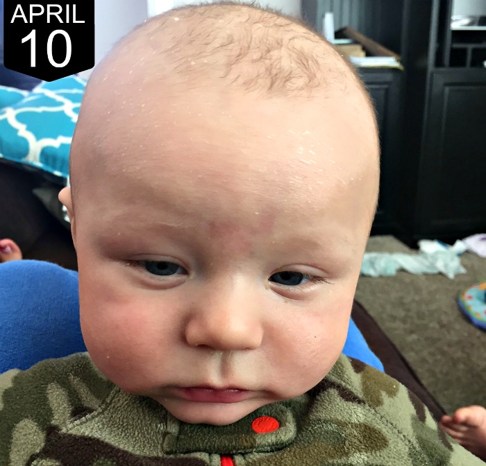 What we did for our infant's eczema