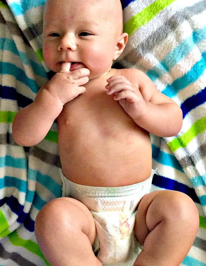 Baby Eczema