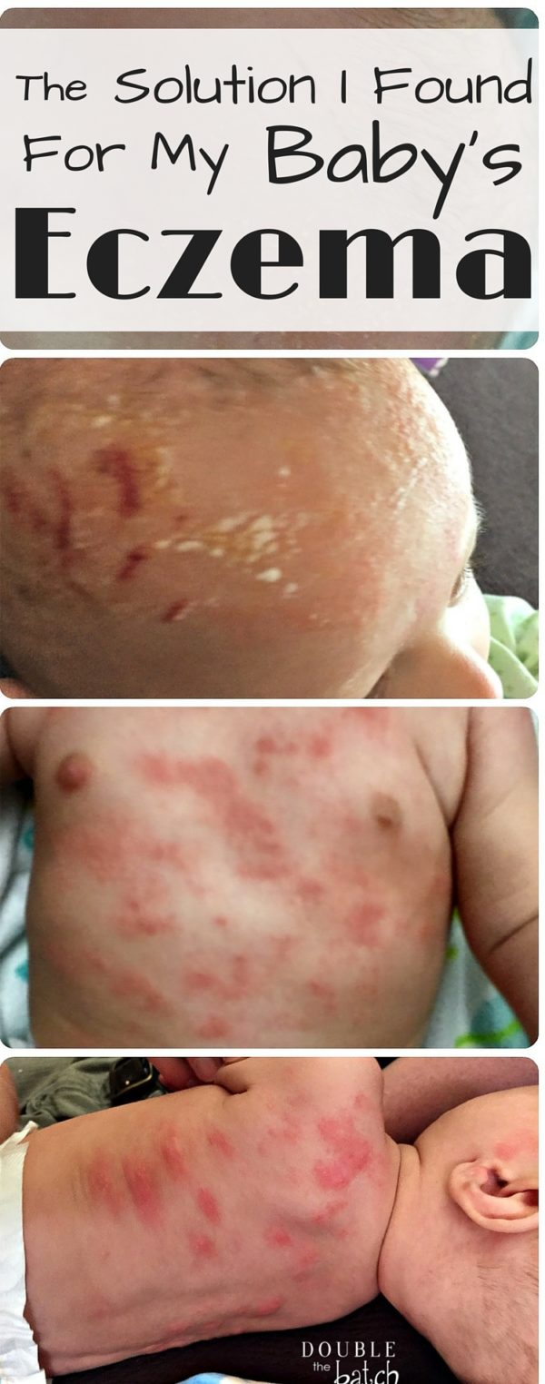 Eczema on Babies What We did for my Infant's Eczema That WORKED