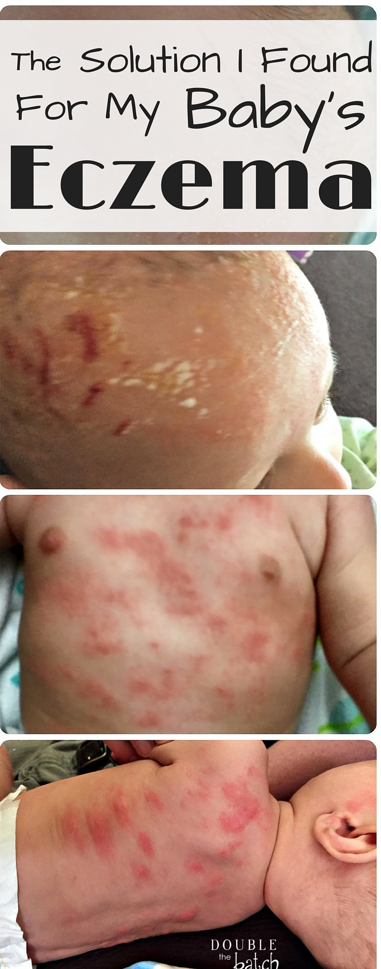 After Exhausting Myself with various different things, we finally found a solution for my baby's eczema!