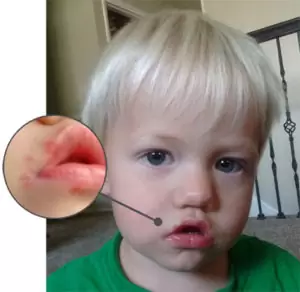 impetigo in children face