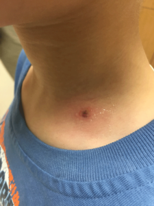 How to Prevent, Remove, and Treat a Tick Bite