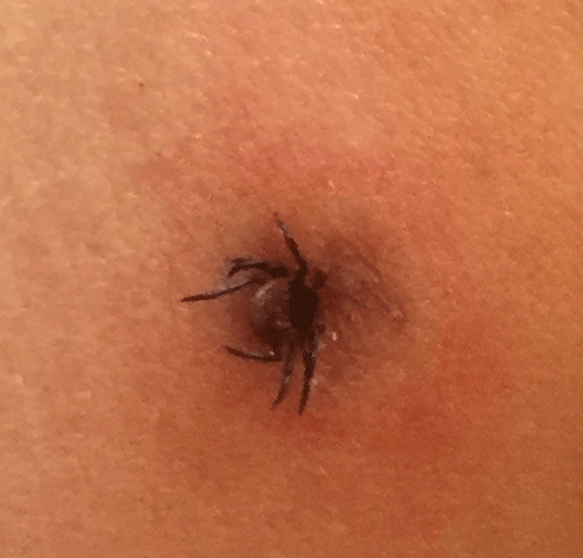 How to Prevent, Remove, and Treat a Tick Bite