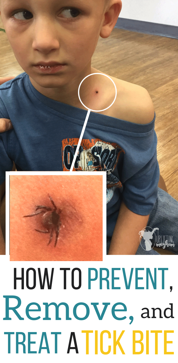 Ticks can be scary! Here is everything you need to know. Know how to prevent, remove and treat a tick bite! This is all the latest information on ticks you need to know...